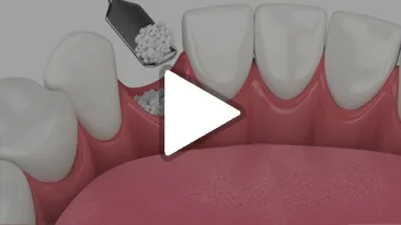 Bone Graft