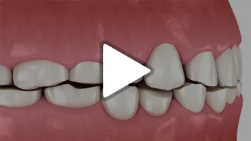 Bruxism