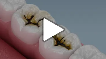 Caries