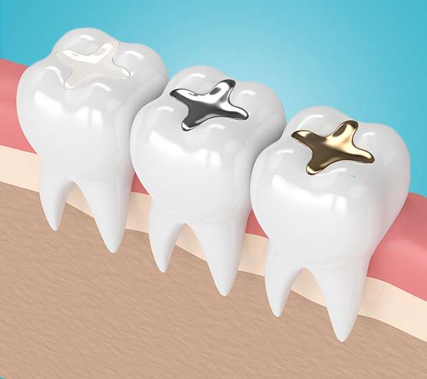 Mountain View Composite Fillings
