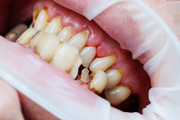 What Happens When A Cracked Tooth Goes Untreated?