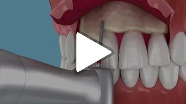 Crown Lengthening