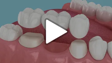 Dental Bridge