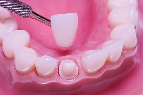 When Is a Dental Crown Recommended? - Smiles Dental Care Mountain View California