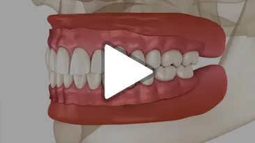 Dental Flipper
