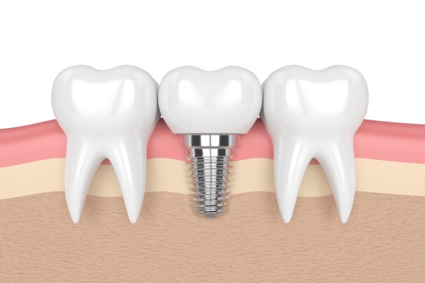 Choose Dental Implants To Replace Missing Teeth