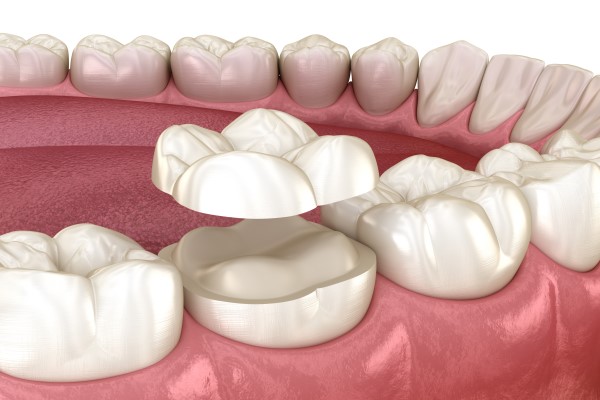 What Is A Dental Onlay?
