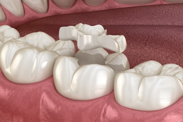 Dentists Answer FAQs About Onlays And Inlays
