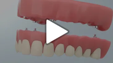 Denture Stabilization