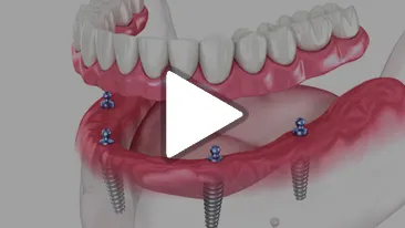 Dentures