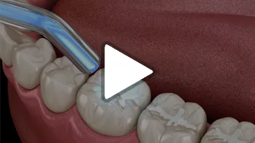 Fillings