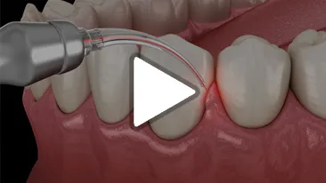 Frenectomy