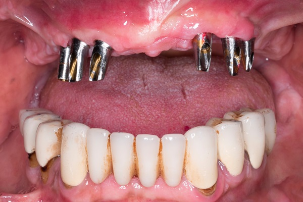 Full Mouth Reconstruction For Tooth Restoration