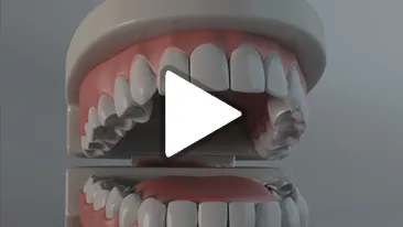 Full Mouth Restoration