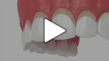 Gingivectomy