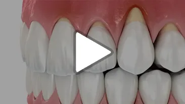 Gum Recession