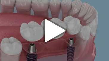 Implant Bridge