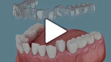 Invisible Aligners