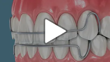 Lower Lingual Holding Arch