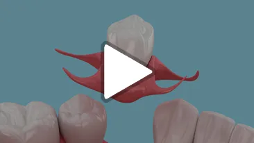 Mini Implants