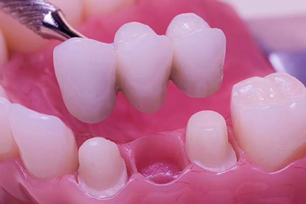 Dental Procedures To Replace Missing Teeth
