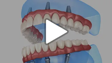 Multi Implant Minis