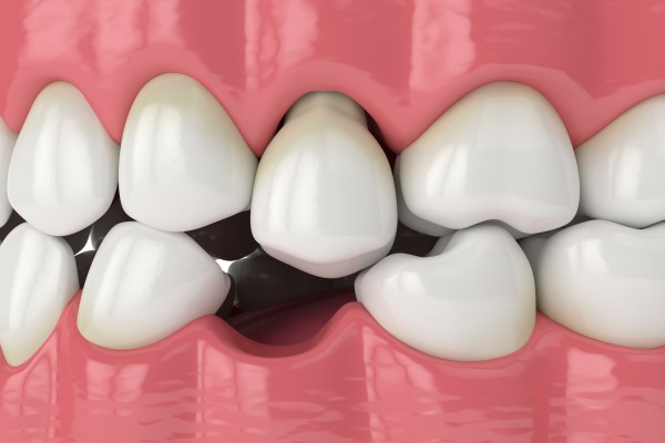 Why A Missing Tooth Should Be Replaced