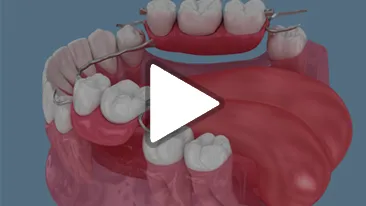 Partial Dentures
