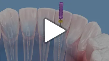 Root Canal