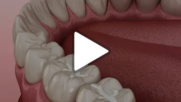 Sealants