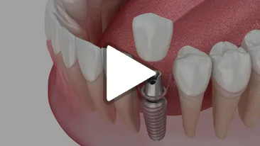 Single Implant Minis