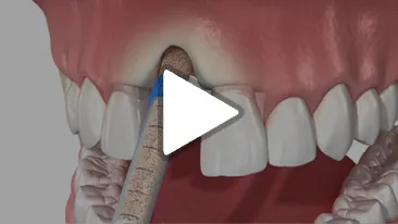 Sinus Augmentation