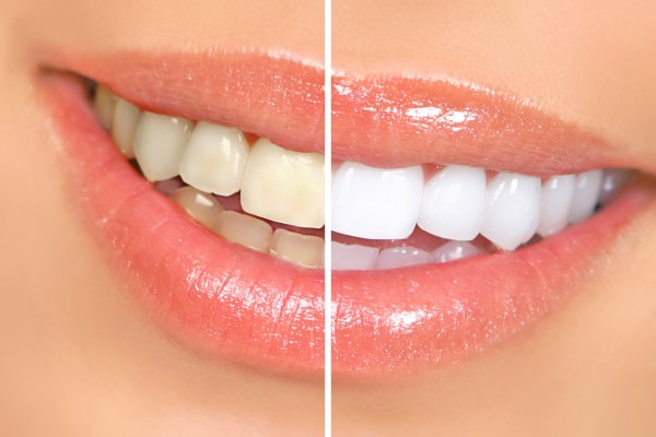 Quick Guide To Professional Teeth Bleaching
