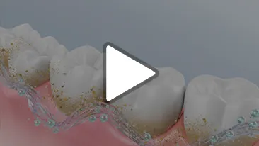 Teeth Whitening