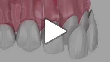 Veneers