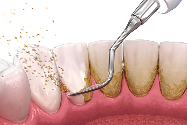 oral-hygiene-basics-what-are-tartar-and-plaque